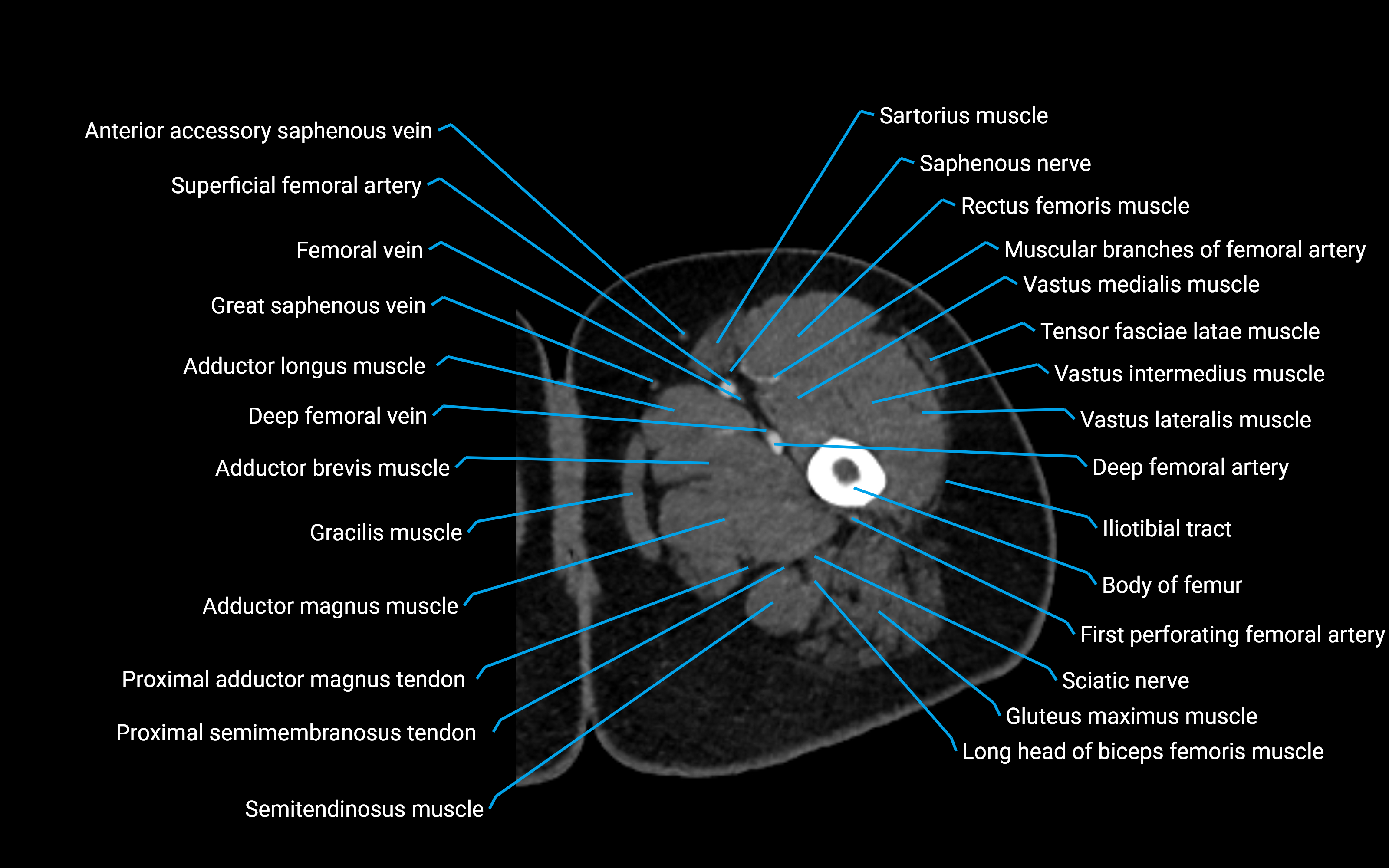 CT Hip axial cross sectional anatomy labelled image 27 (3).png